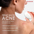 D’Acne Soap